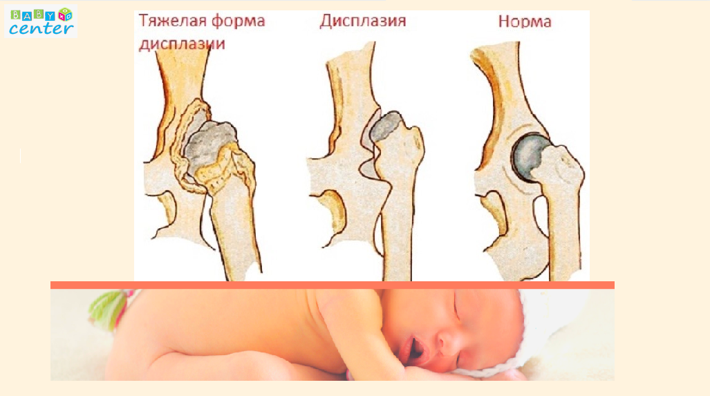 3_показатели_дисплазии.png