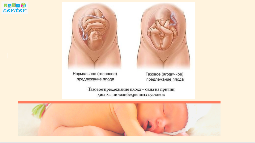 тазовое_предлежание_плода.png